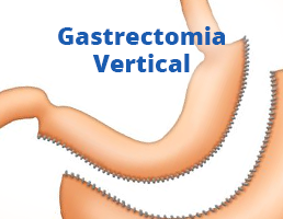 Gastrectomia vertical