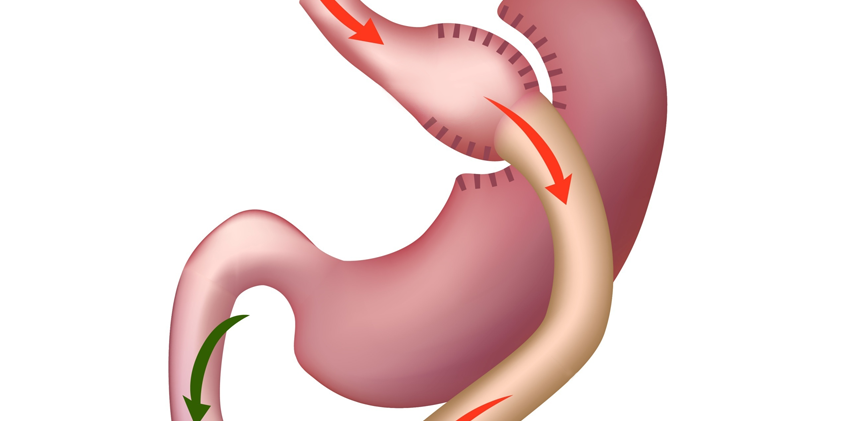 cirurgia-bariatrica-bypass blogimage